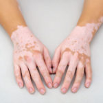 Tratamiento para el leucoderma: alopatía y Ayurveda