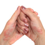 Psoriasis: El manejo en Medicina Ayurveda