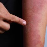 Dermatitis atópica tratamiento en Ayurveda