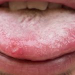 Cándida sistémica. El poder sanador del Ayurveda