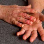 Raynaud consejos en Ayurveda