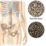 La prevalencia de la osteoporosis en mujeres posmenopáusicas
