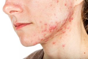 Acné Ayurveda