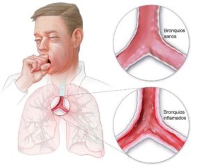 Bronquitis Ayurveda