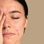Acné con Ayurveda