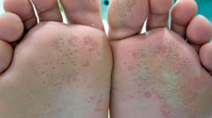 Pie de atleta Ayurveda