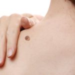 Verrugas con Ayurveda