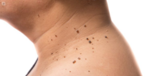 Verrugas Ayurveda
