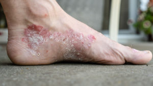 Eczema y Ayurveda