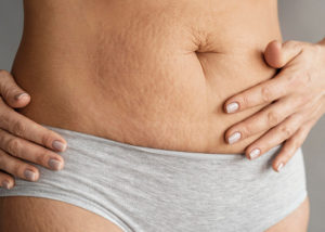 Celulitis Ayurveda