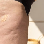 Celulitis y Ayurveda