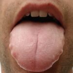Lengua festoneada y Ayurveda